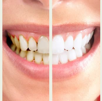 Service Détartrage et Polissage - Cabinet du Dr Nader Maqboli