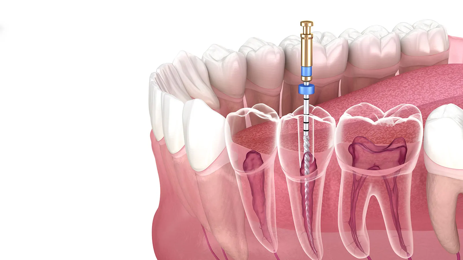 Service Endodontie Précise - Cabinet du Dr Nader Maqboli