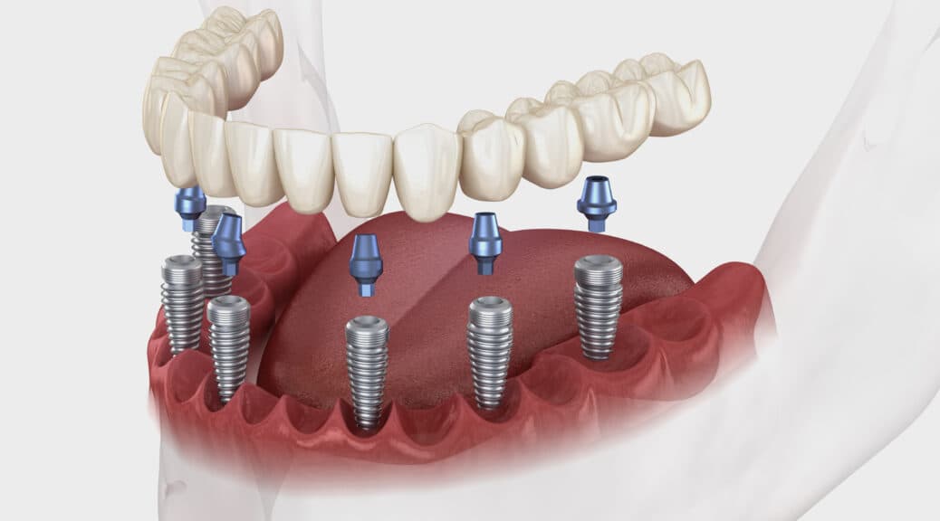 Service Implants Dentaires & Chirurgie - Cabinet du Dr Nader Maqboli